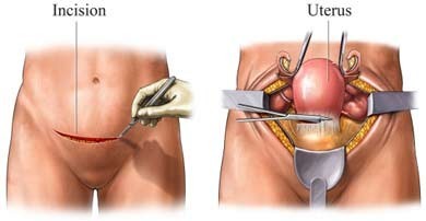 laparoscopic hysterectomy before and after